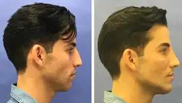 jawline transformation