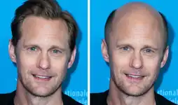 male hair vs balding